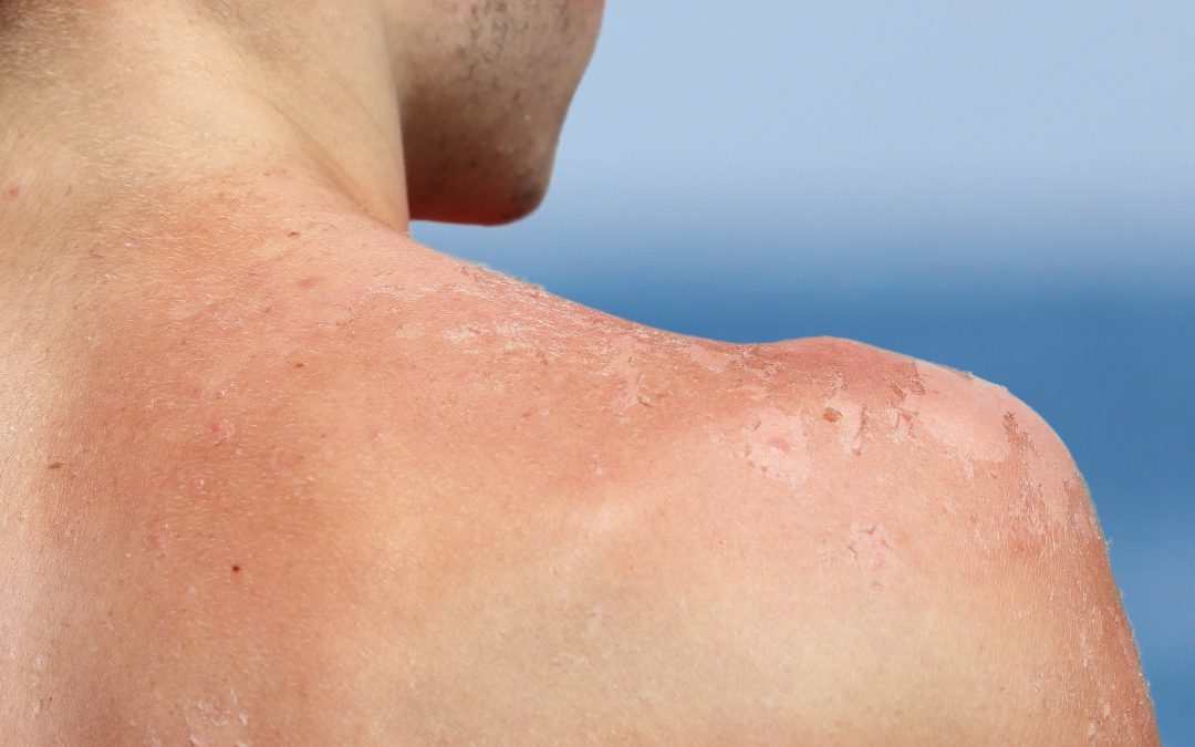 How Long Does Sun Poisoning Last?